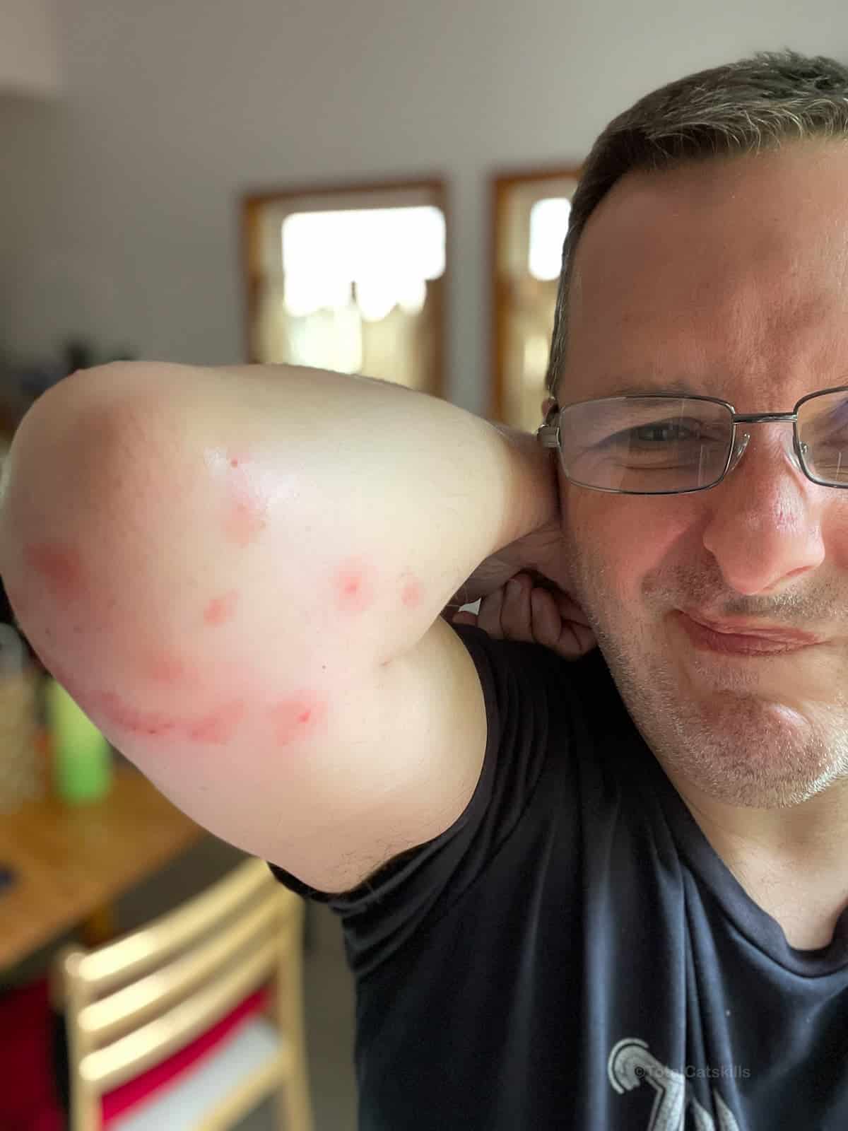 Sean’s arm covered in black fly bites