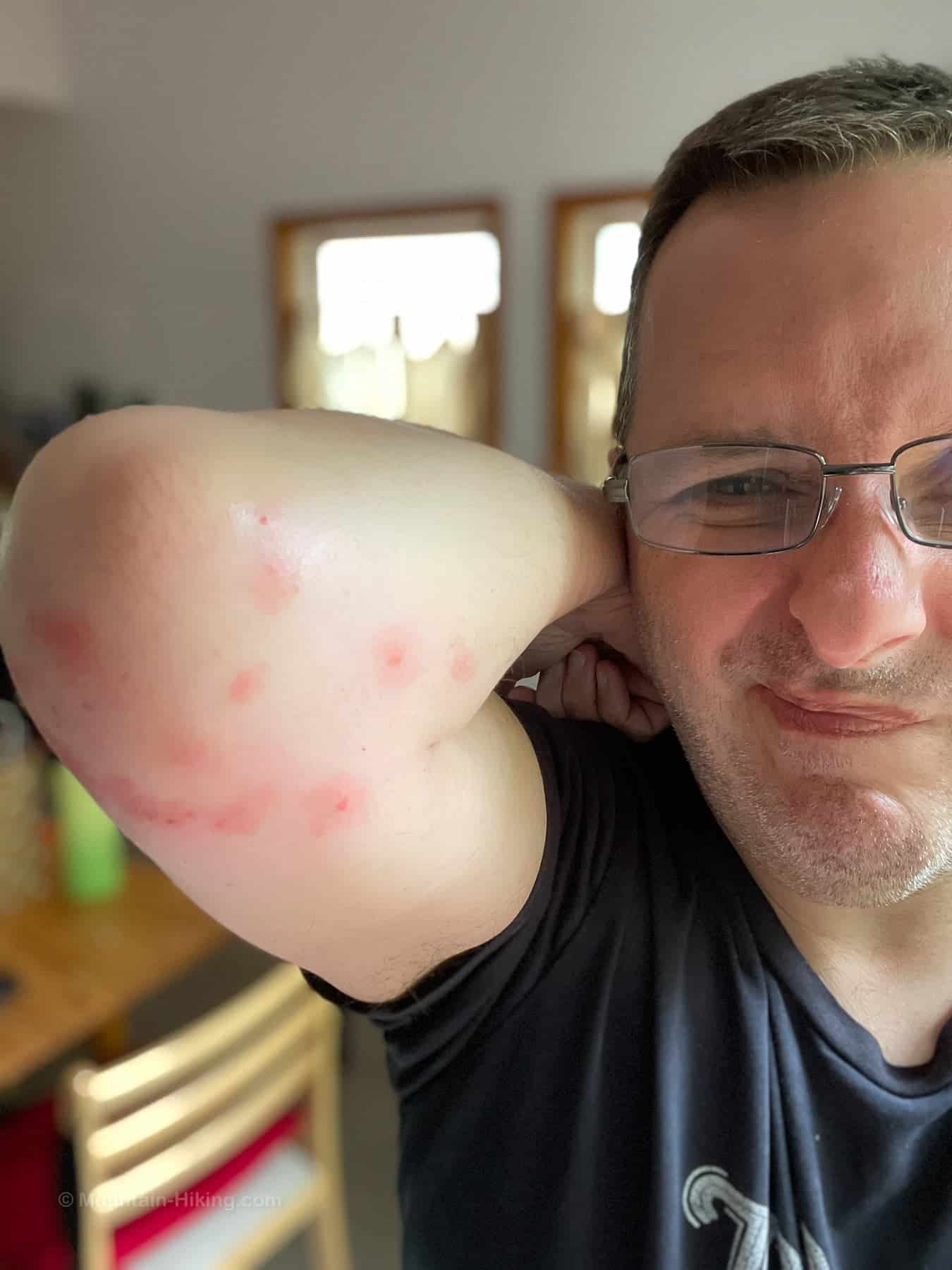 mosquito bites on exceptionally white male